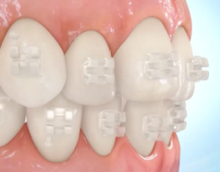 aparelho ortodontico estetico