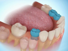 ortodontia perda de dente de leite