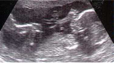 Ultrassom de bebê chupando dedo dentro do útero.